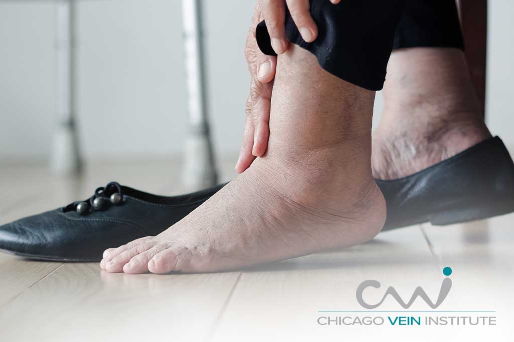 A Closer Look at Chronic Venous Insufficiency: Understanding